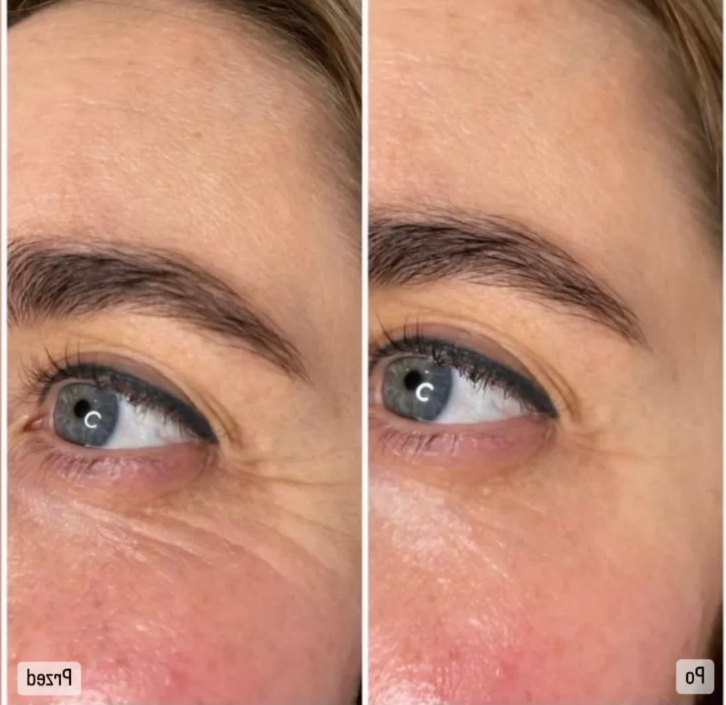 Redukcja zmarszczek wokół oczu laserem frakcyjnym nieablacyjnym LaserMe – przed i po – Aleksandra Walas Estetic Rzeszów
