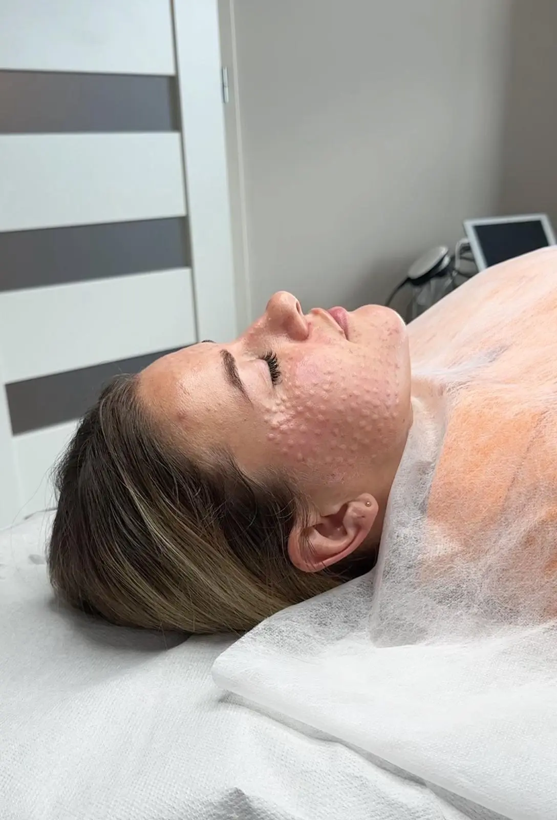 Mezoterapia igłowa Rzeszów – zabieg odżywiający skórę twarzy
