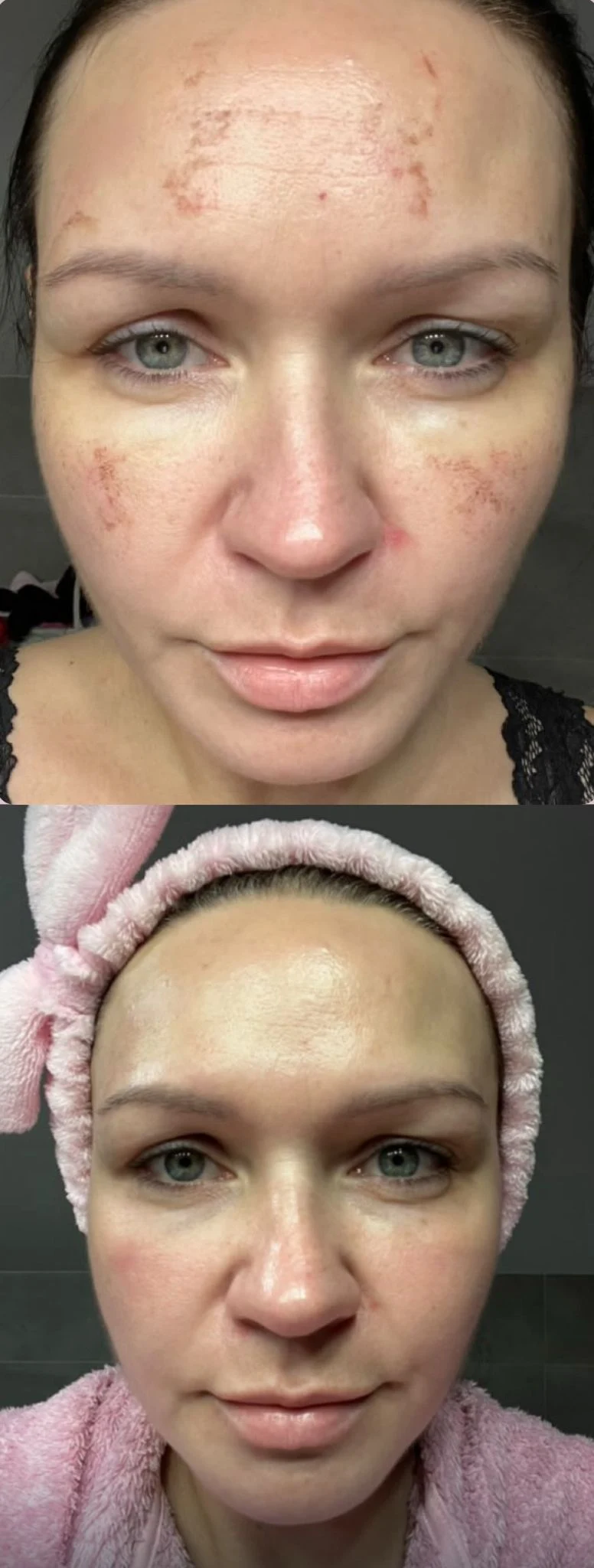 Laser DYE-VL – usuwanie przebarwień na czole, efekt przed i po, Aleksandra Walas Estetic Rzeszów