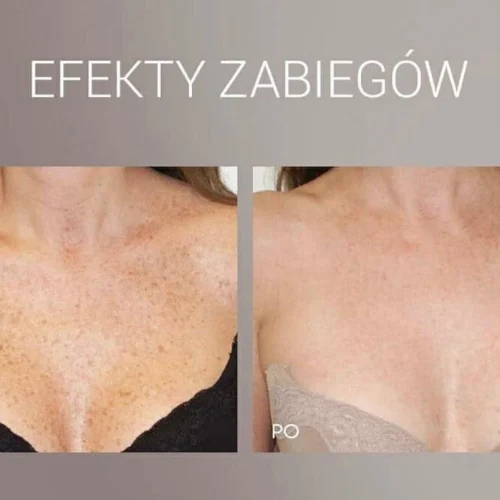 Efekt laserowego usuwania przebarwień dekoltu Rzeszów
