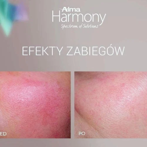 Efekty laserowego zamykania naczynek Rzeszów – redukcja rumienia