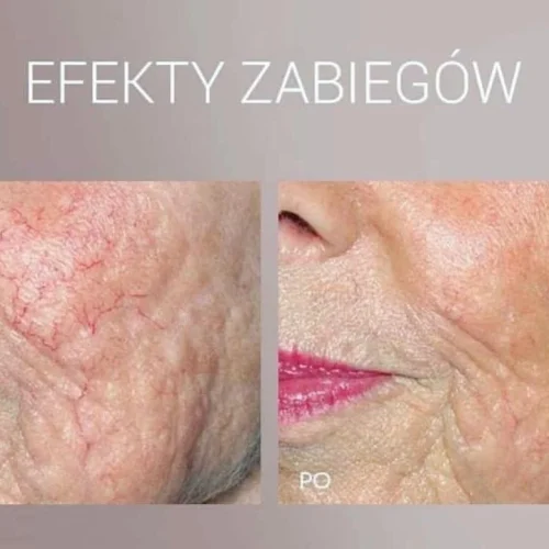 Efekty laserowego usuwania przebarwień i naczynek na policzkach Rzeszów