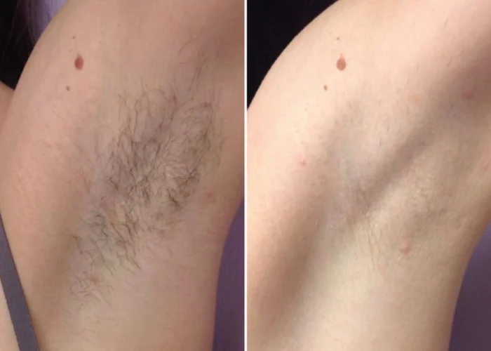 Efekty depilacji laserowej pach w Rzeszowie – Primelase Excellence