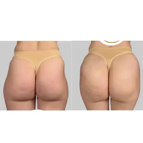 Efekt-zabiegu-modelowania-posladkow-Rzeszow-Aleksandra-Walas-1-1-e1757500279260.webp