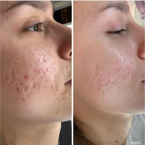 Redukcja blizn potrądzikowych laserem frakcyjnym nieablacyjnym LaserMe – przed i po – Aleksandra Walas Estetic Rzeszów