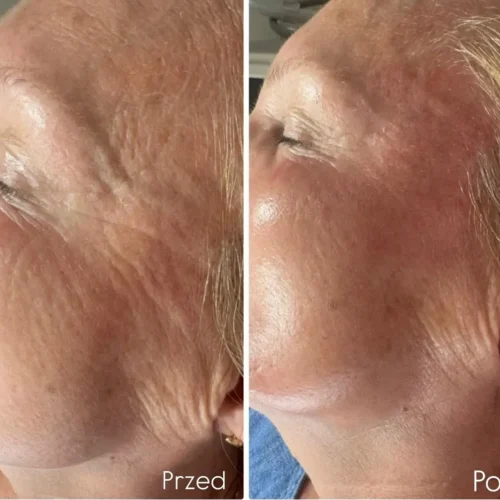 Odmłodzenie skóry wokół oczu laserem frakcyjnym nieablacyjnym LaserMe – przed i po – Aleksandra Walas Estetic Rzeszów
