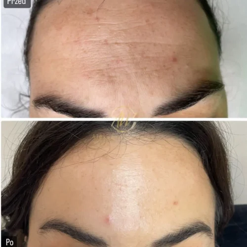 Wygładzenie zmarszczek czoła laserem frakcyjnym nieablacyjnym LaserMe – przed i po - Aleksandra Walas Estetic Rzeszów