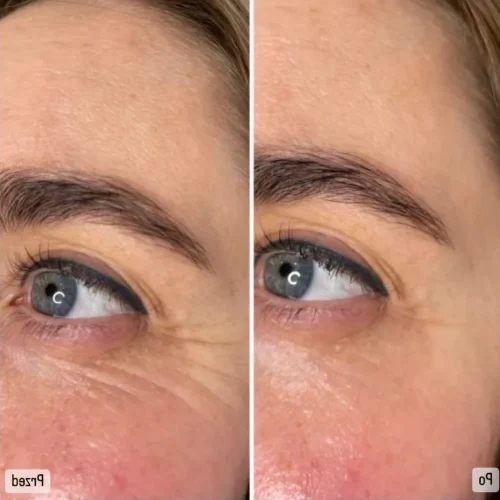Redukcja zmarszczek wokół oczu laserem frakcyjnym nieablacyjnym LaserMe – przed i po – Aleksandra Walas Estetic Rzeszów