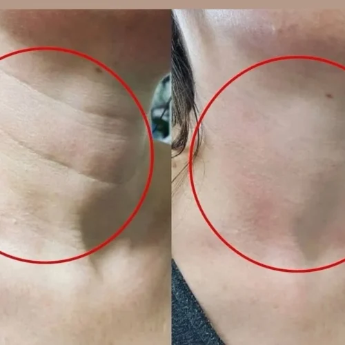 Efekt zabiegu kwasem polimlekowym PLLA na szyję Rzeszów
