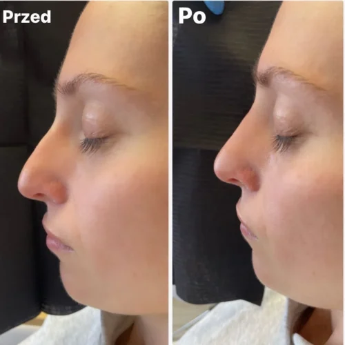 Efekty zabiegu modelowania nosa i volumetrii nosa Rzeszów
