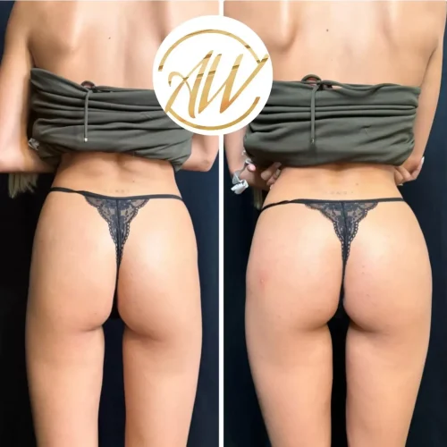 Efekty-zabiegu-modelowania-posladkow-Rzezszow-Aleksandra-Walas-e1758485968791.webp