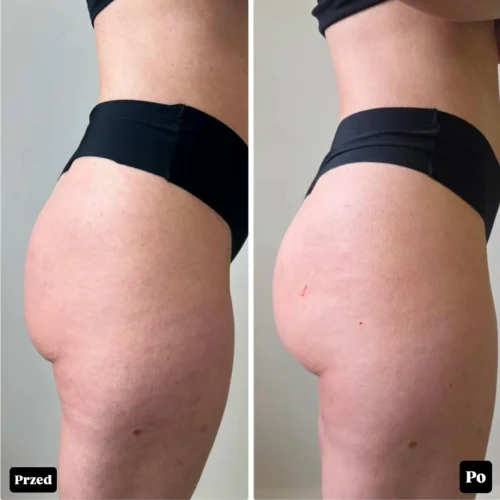 Kwas PLLA Rzeszów – naturalny lifting pośladków