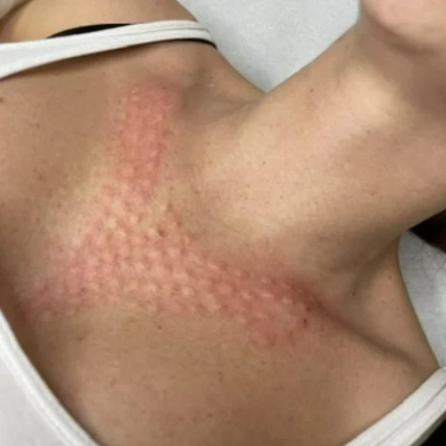 Mezoterapia igłowa Rzeszów – regeneracja i napięcie skóry dekoltu