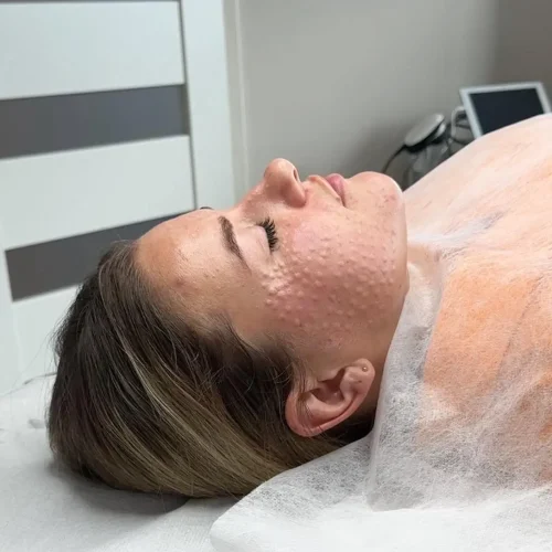 Mezoterapia igłowa Rzeszów – zabieg odżywiający skórę twarzy