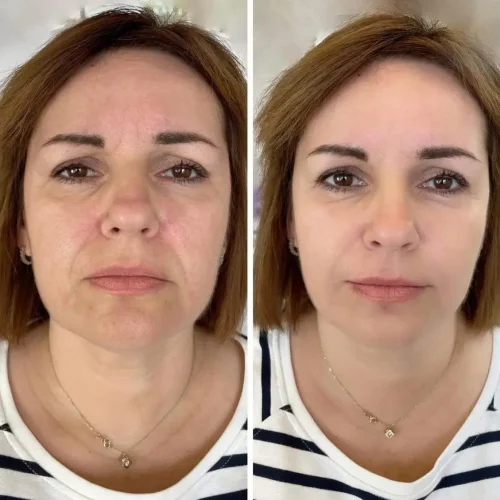 Stymulatory tkankowe Rzeszów – efekty przed i po zabiegu
