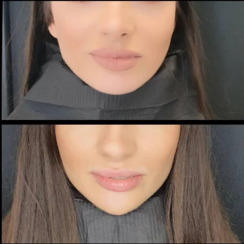 Modelowanie brody kwasem hialuronowym – efekt przed i po | Aleksandra Walas Estetic Rzeszów